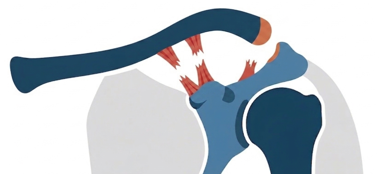 Ilustração anatômica da luxação acromioclavicular no topo do ombro